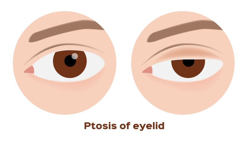 Mắt bị sụp mí 1 bên phải làm sao để khắc phục?